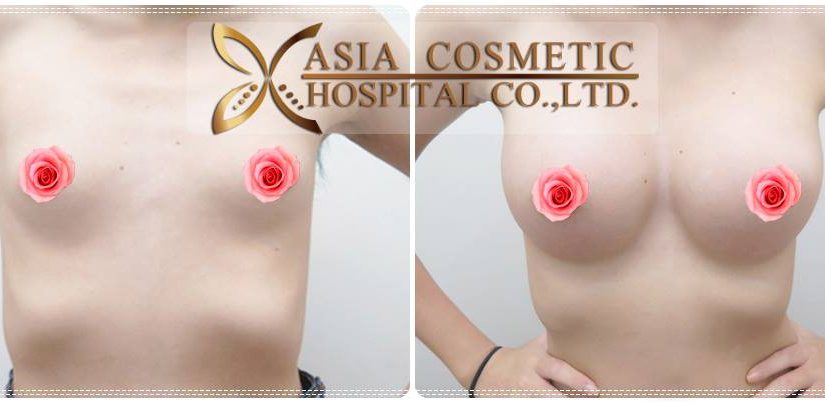 รีวิวทำนมสวย