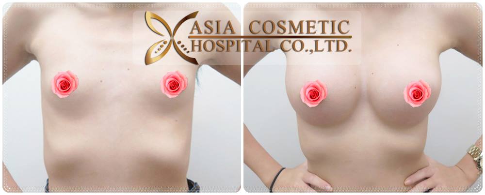 รีวิวทำนมสวย