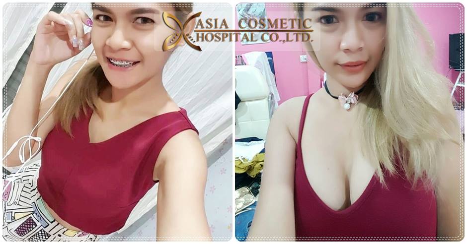 รีวิวศัลยกรรมเสริมหน้าอก