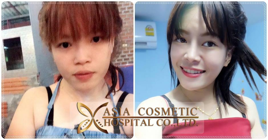 รีวิวเสริมจมูก