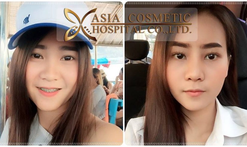 รีวิวเสริมจมูกครั้งแรก