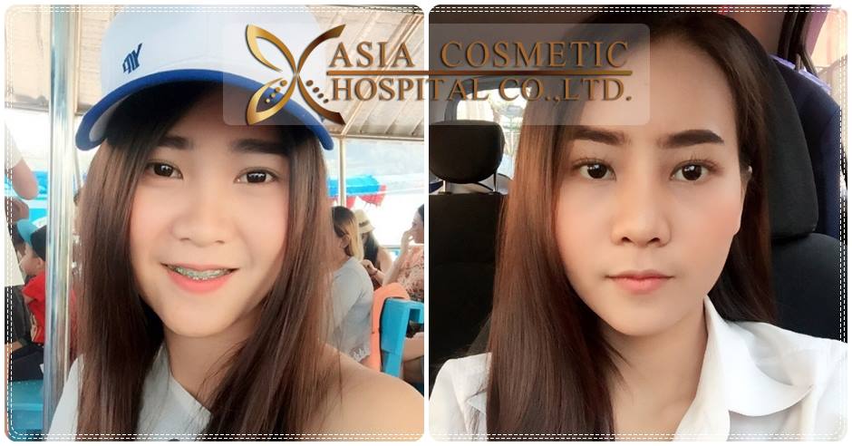 รีวิวเสริมจมูกครั้งแรก