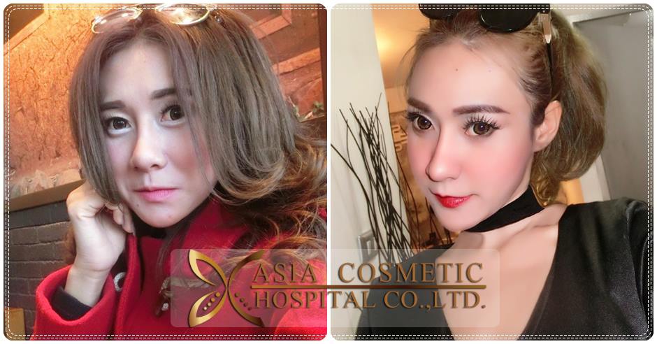 รีวิวแก้จมูก