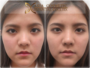 รีวิวแก้ไขจมูก 1เดือน