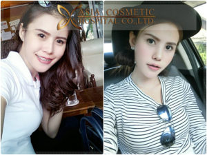 รีวิวแก้ไขจมูก แต่งปลาย