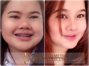 รีวิวแก้ไขจมูก แต่งปลายเนื้อเยื่อสังเคราะห์