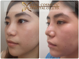 รีวิวโรงพยาบาลเอเซีย แก้ไขจมูก