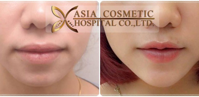 ศัลยกรรมเสริมคาง