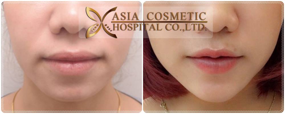 ศัลยกรรมเสริมคาง