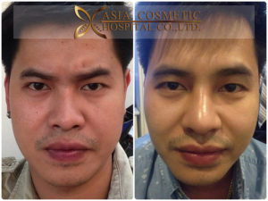 ศัลยกรรมตกแต่งจมูก แก้จมูก