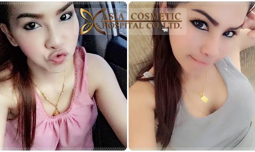 เสริมหน้าอก