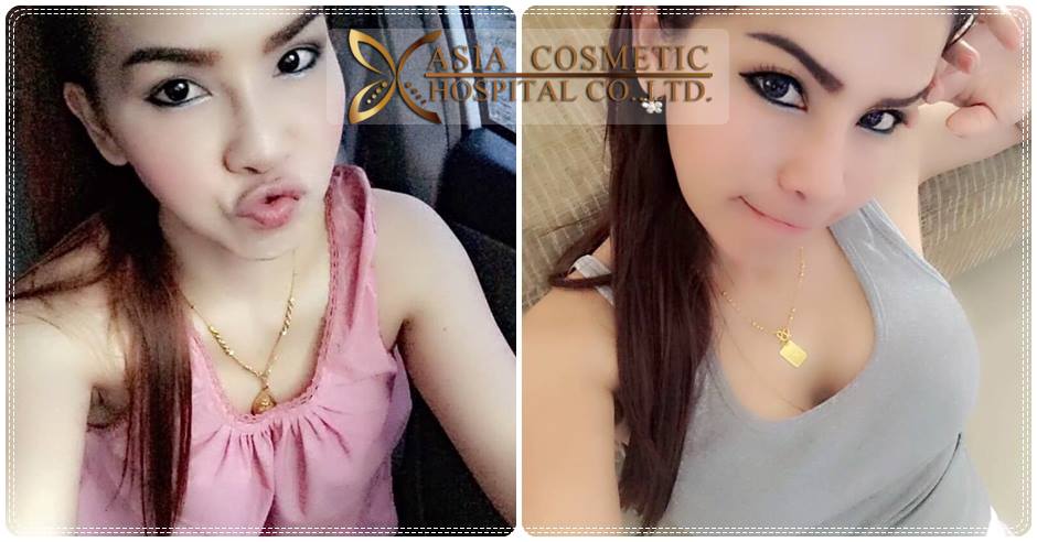 เสริมหน้าอก