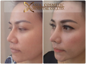 แก้จมูก ตัดปีก