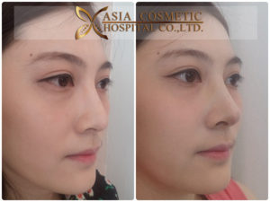 แก้จมูกดีที่สุด