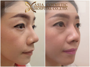 แก้ไขจมูก