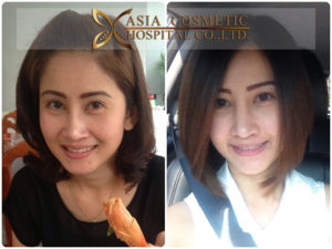 แก้ไขจมูก เลาะผังผืด