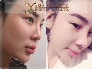 แก้ไขจมูก เลาะผังผืดเก่า