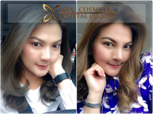 แก้ไขจมูก แต่งปลายเนื้อเยื่อสังเคราะห์