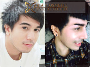 แก้ไขจมูกแต่งปลาย ผู้ชาย