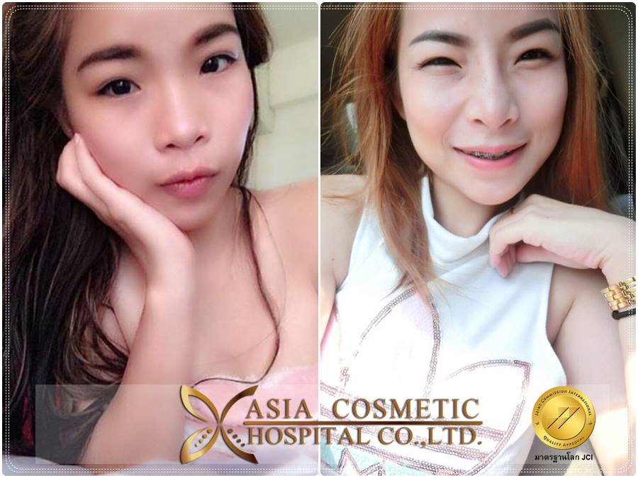 การทำศัลยกรรมจมูก