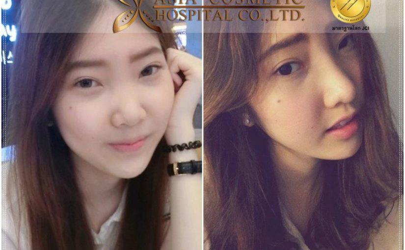 การทำศัลยกรรมเสริมจมูก