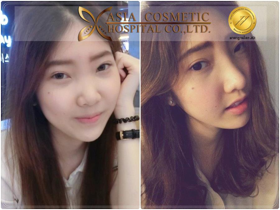 การทำศัลยกรรมเสริมจมูก