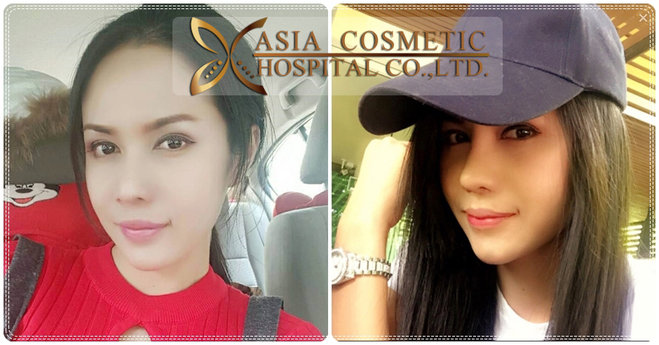 การผ่าตัดตกแต่งปลายจมูก