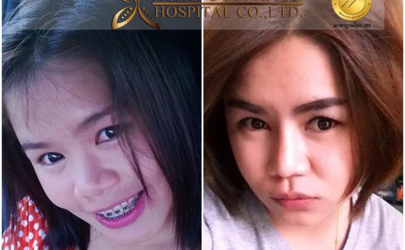 การศัลยกรรมเสริมจมูก