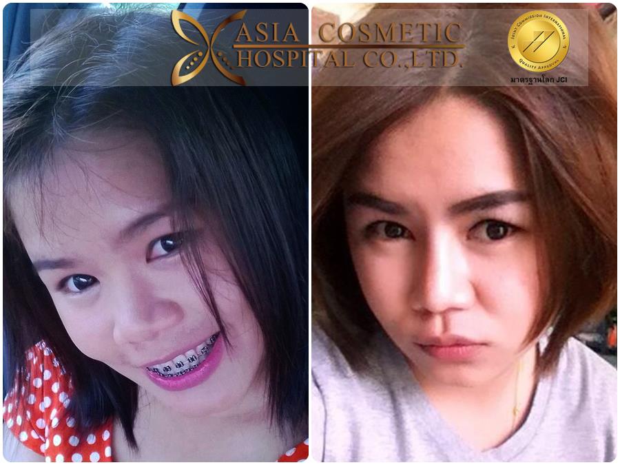 การศัลยกรรมเสริมจมูก