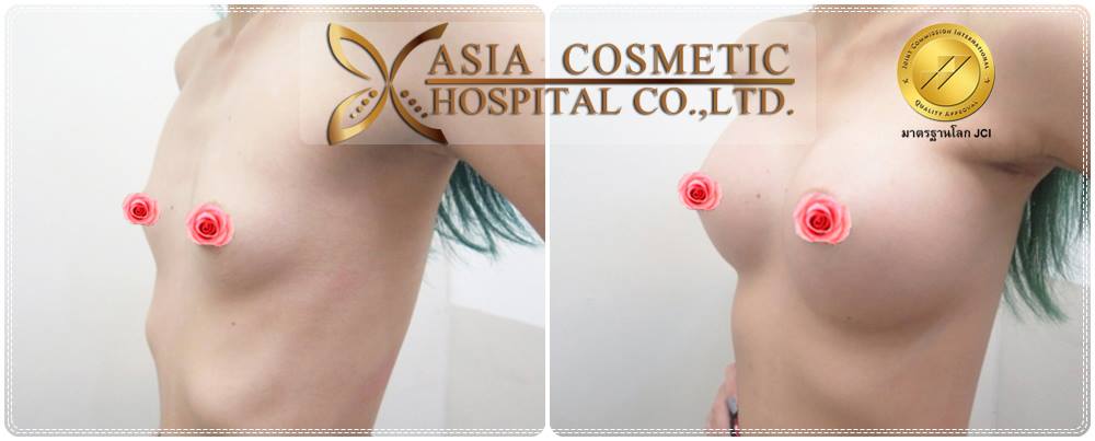 การศัลยกรรมเสริมหน้าอก