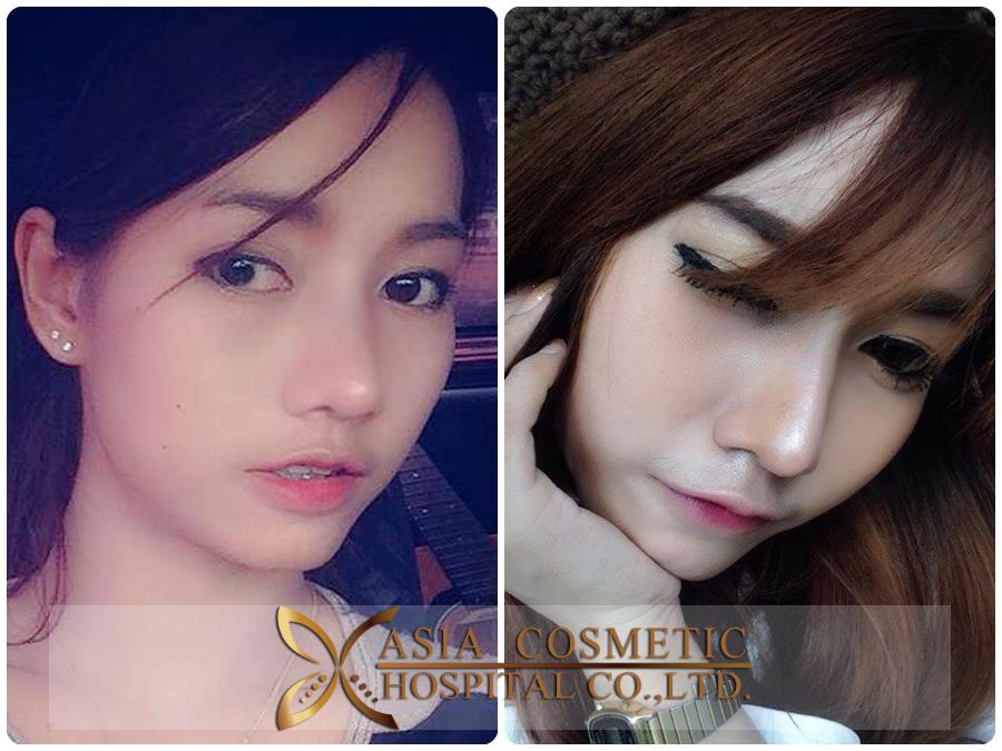 รีวิวทำดั้ง