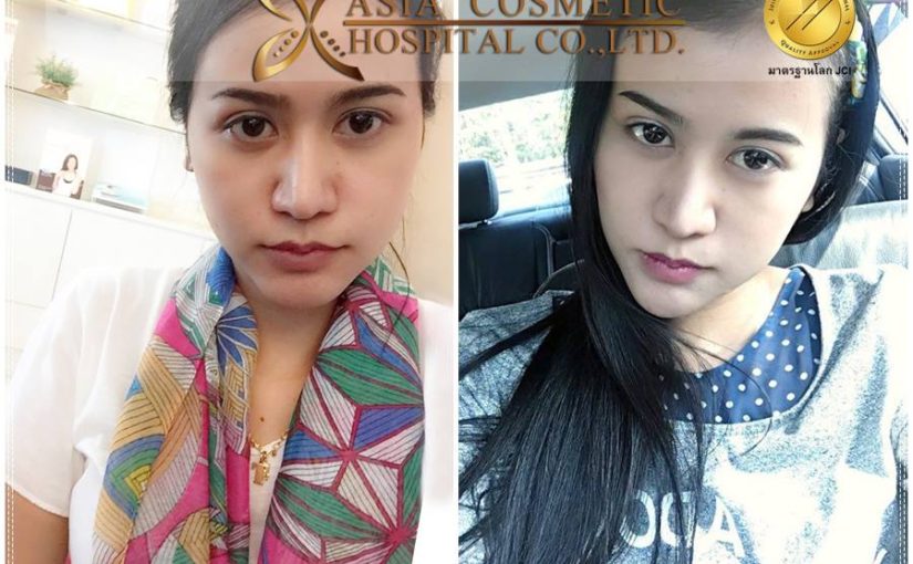 รีวิวประสบการณ์เสริมคาง