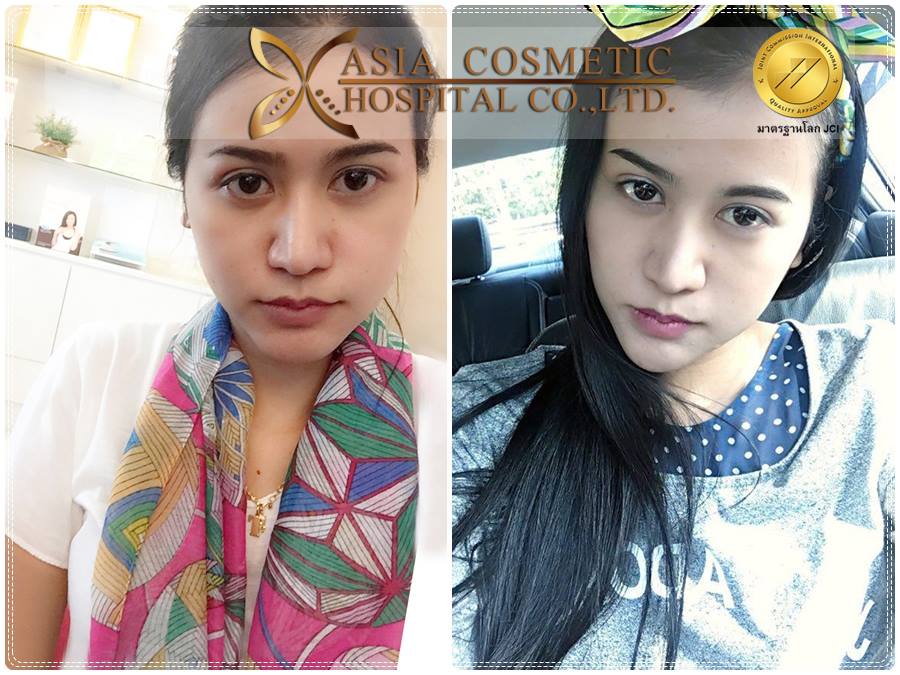 รีวิวประสบการณ์เสริมคาง