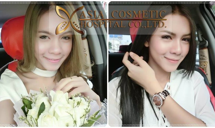 รีวิวเสริมดั้ง