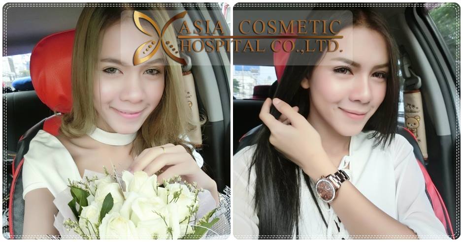 รีวิวเสริมดั้ง