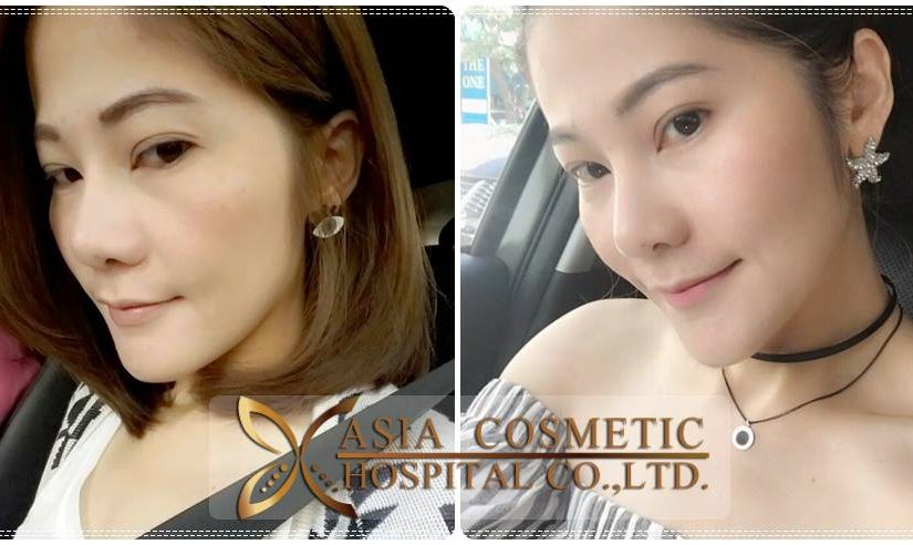 ศัลยกรรมตัดปีกจมูก