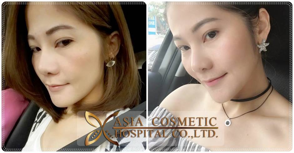 ศัลยกรรมตัดปีกจมูก