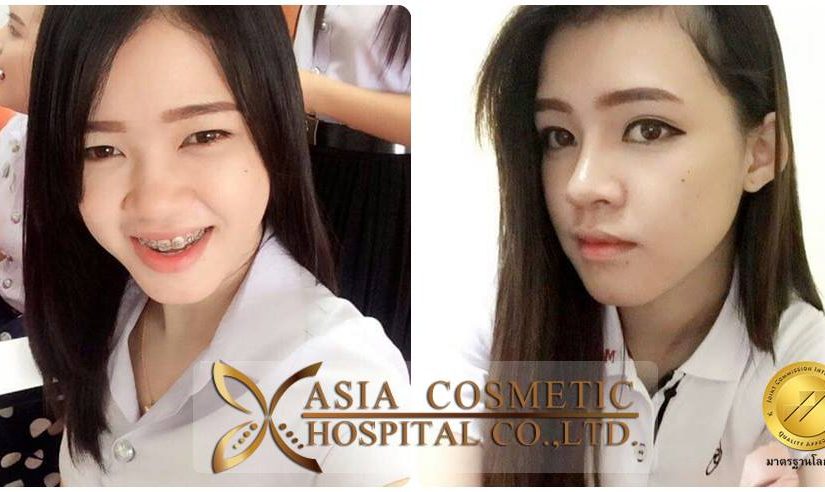 เสริมจมูกกับโรงพยบาลเอเชียคอสเมติก