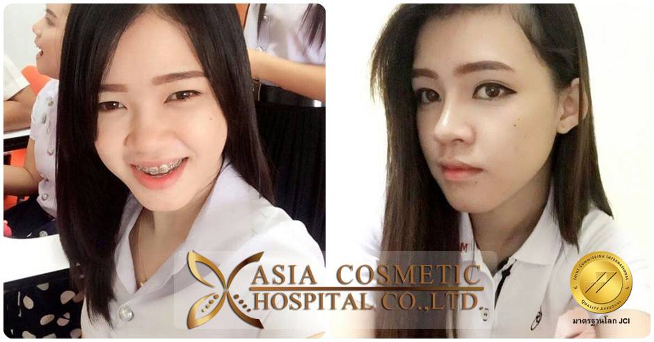 เสริมจมูกกับโรงพยบาลเอเชียคอสเมติก