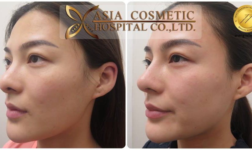 แก้จมูกกับคุณหมอทนงศักดิ์