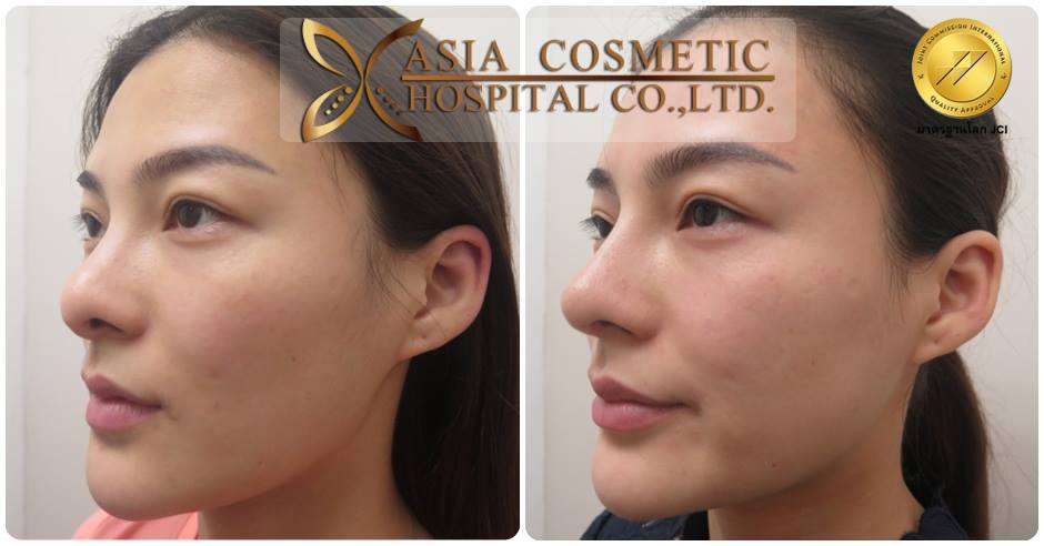 แก้จมูกกับคุณหมอทนงศักดิ์