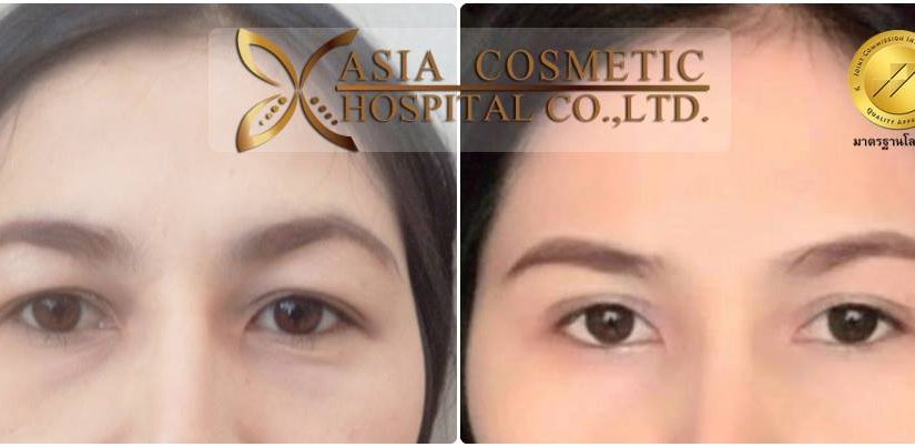 ทำศัลยกรรมตา2ชั้นแบบกรีด