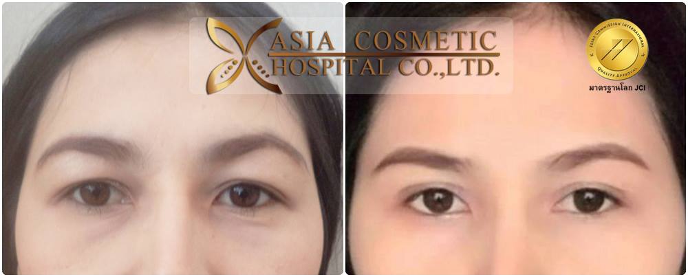 ทำศัลยกรรมตา2ชั้นแบบกรีด