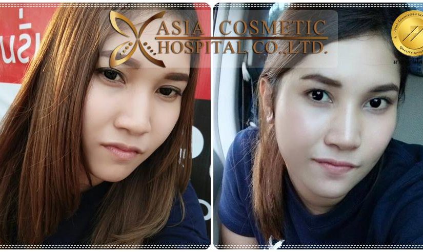 รีวิวจมูก