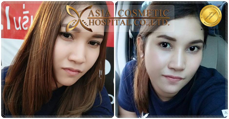 รีวิวจมูก