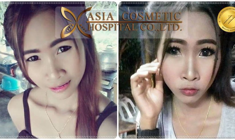 รีวิวทำจมูกที่ไหนเอเซีย