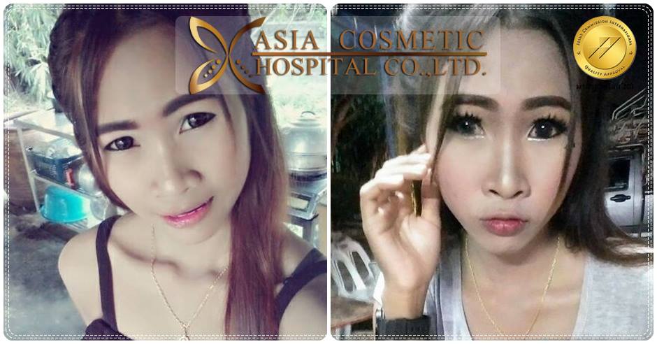 รีวิวทำจมูกที่ไหนเอเซีย