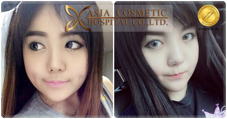 รีวิวศัลยกรรมตัดกราม