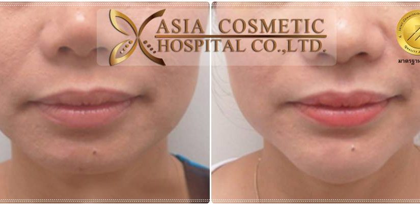 รีวิวเสริมคาง-เอเซียคอสเมติก