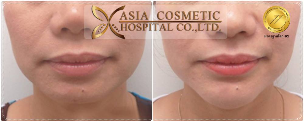 รีวิวเสริมคาง-เอเซียคอสเมติก